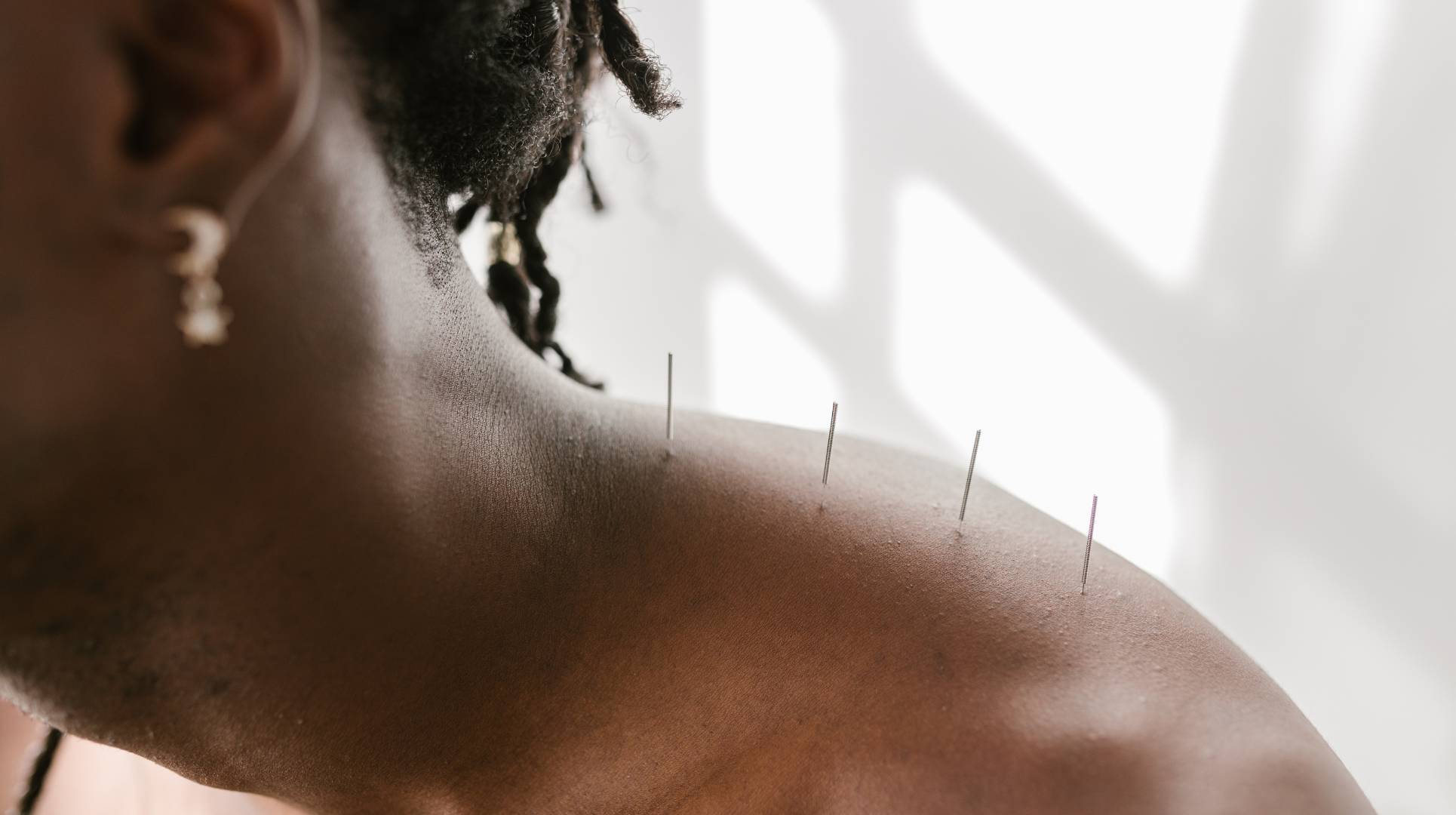 Say Goodbye to Pain: How Acupuncture Can Help You With Pain Management